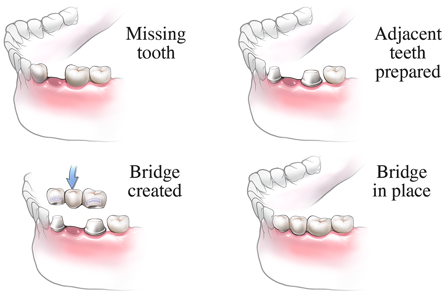 Dentist showing a model of a dental bridge